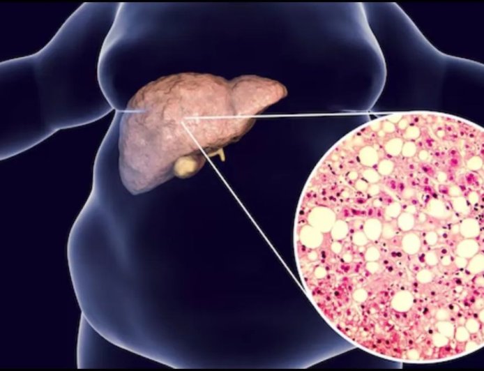 IIT कानपुर का कमाल: फैटी लिवर के इलाज के लिए बना क्रांतिकारी स्प्रे, लाखों मरीजों को नई उम्मीद