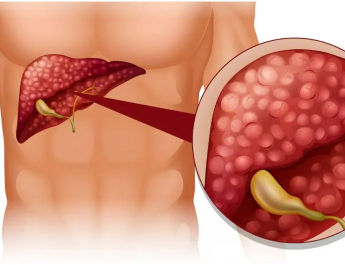 फैटी लिवर का बढ़ता खतरा: अनहेल्दी खान-पान, मोटापा और शराब बन सकते हैं बड़ी वजह
