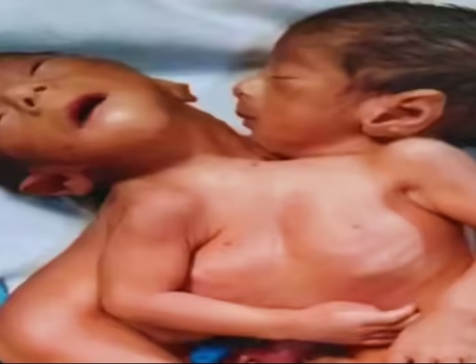 अलीगढ़ में चौंकाने वाला मामला: दो सिर वाले जुड़वां बच्चों का जन्म, सदमे में मां की मौत