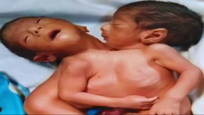 अलीगढ़ में चौंकाने वाला मामला: दो सिर वाले जुड़वां बच्चों का जन्म, सदमे में मां की मौत