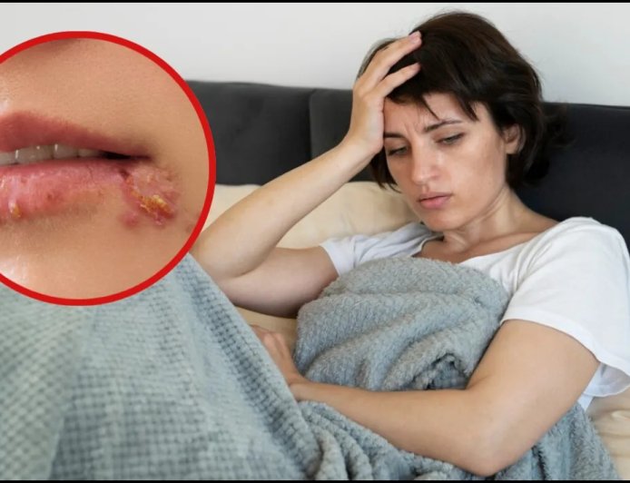 बुखार के बाद होंठों पर दाने क्यों निकलते हैं? जानिए कारण और आसान इलाज